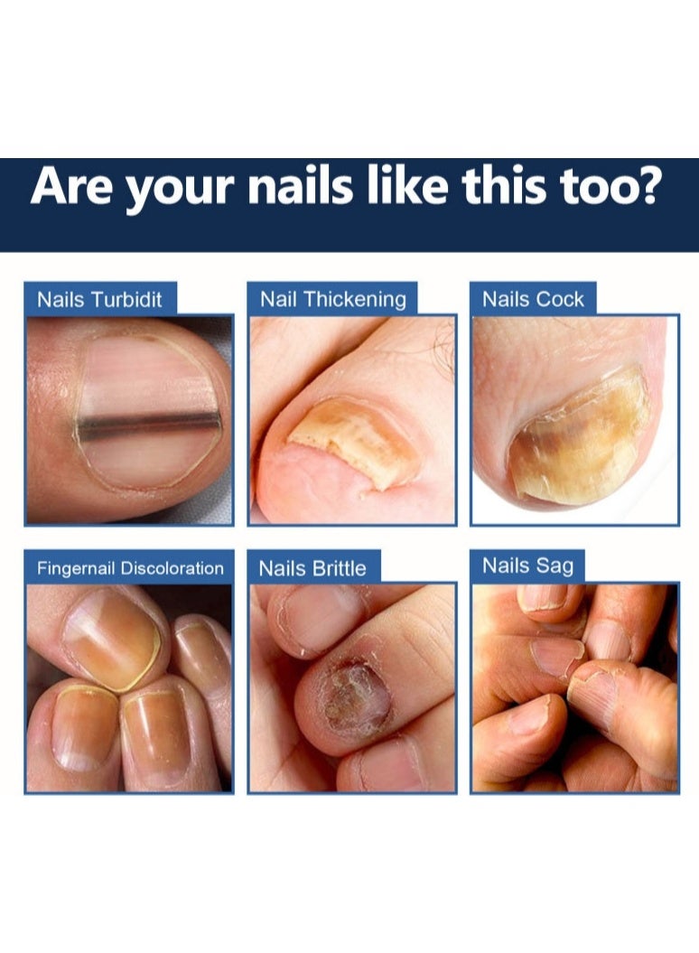 ERAYCEE Nail Fungus Treatment Cream, 20g Toenail Fungus Treatment Cream - Image 3